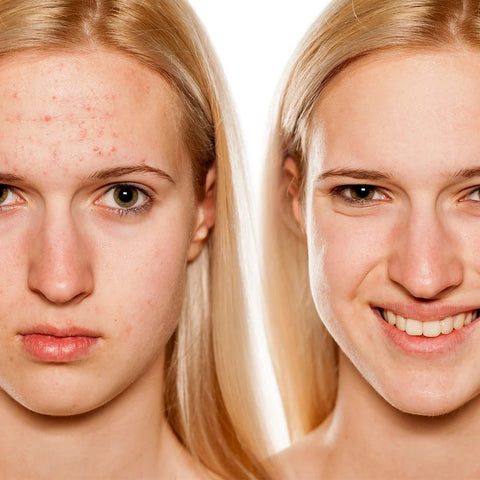 LIROMA® LED - Lichttherapiemaske mit Infrarot- und Rotlicht